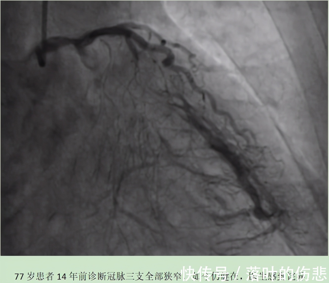冠脉造影|冠心病拒绝支架,14年后仍健在,医生诧异!原来他只做对了两件事