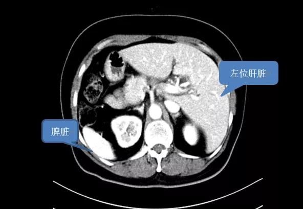 医生|“镜面人”患上胆管癌！心肝脾肺全长反，医生“反着做手术”完成胰十二指肠切除