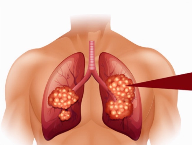医生|肺癌一查就是晚期其实双腿早就给了信号，只是大多数人都忽视了