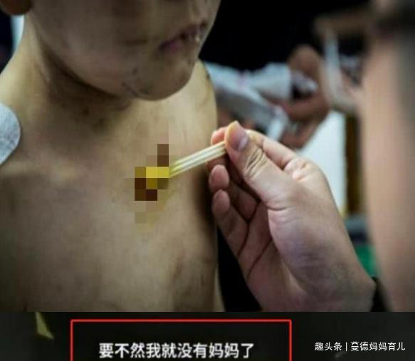 亲妈|男孩8个月大吃奶太用力,被亲妈剪刀伤脸,如今6岁不敢恨妈妈