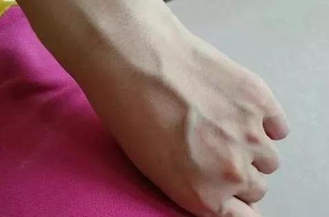 手上青筋越多,说明身体是好是坏青筋究竟是怎么回事