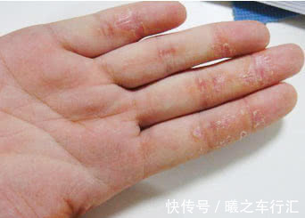 控压|血压高没高？手脚会告知！医生提醒：夏季控压做好三件事，别大意