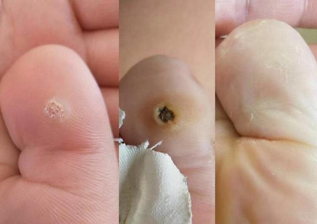 脖子|28岁女子脖子长“肉条”,越来越多,医生别抠,是HPV感染