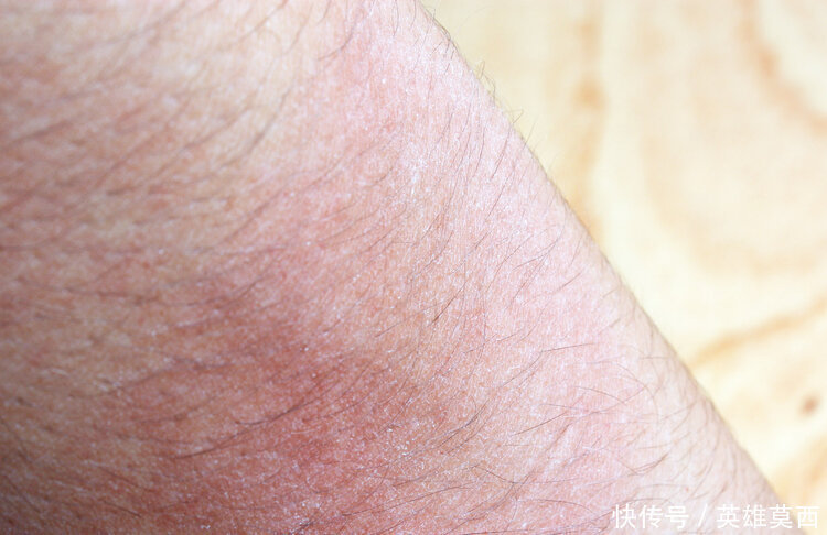 发作|湿疹反复发作奇痒难耐中医给出两种治疗方法,可有效止痒治湿疹