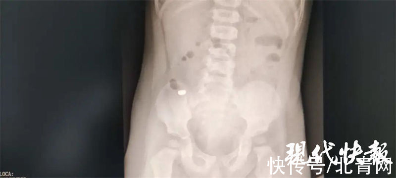 15个月大宝宝误服电池,医生72小时完成“排雷”