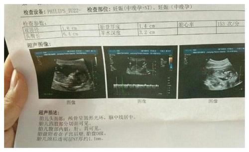b超单|孕检时，B超单上的这3个数据，可能代表怀了个“小帅哥”