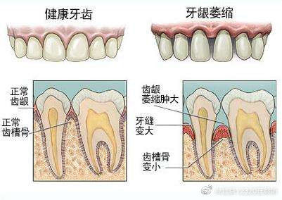 牙周|造成牙龈萎缩的原因有哪些？