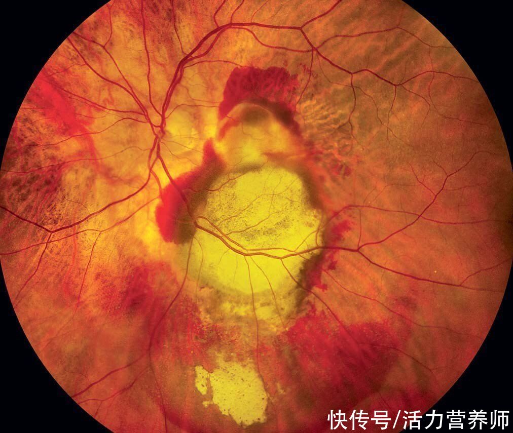 高密度|为什么瘦人不吃肉，血脂水平还很高？判断血脂高低要看这3点