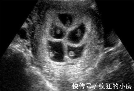 家人|怀孕两个月肚子大的走不动路，得知原因家人既高兴又担忧