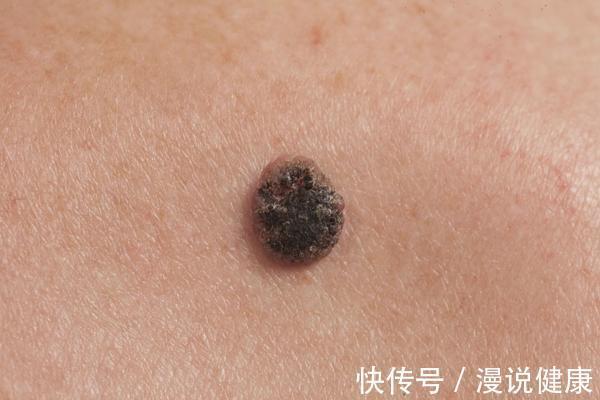分子|哪种“痣”是危险分子?医生提醒:长在这3处的痣,要格外当心