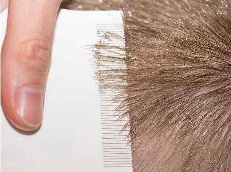 为何30年前农村几乎男女都有虱子,现在怎么没了虱子是哪来的