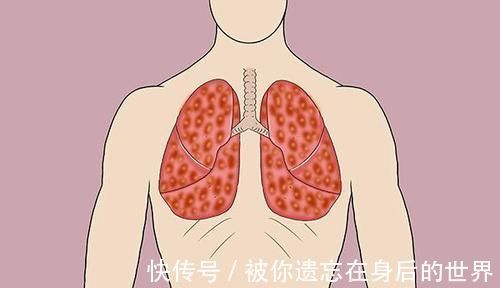 症状|肺内有没有癌,咳嗽先知晓?咳嗽时有2个异常,肺癌或已登门