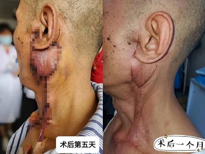 瘤子|肿块长成“土豆”大小，恶化成癌！只因他这个操作→
