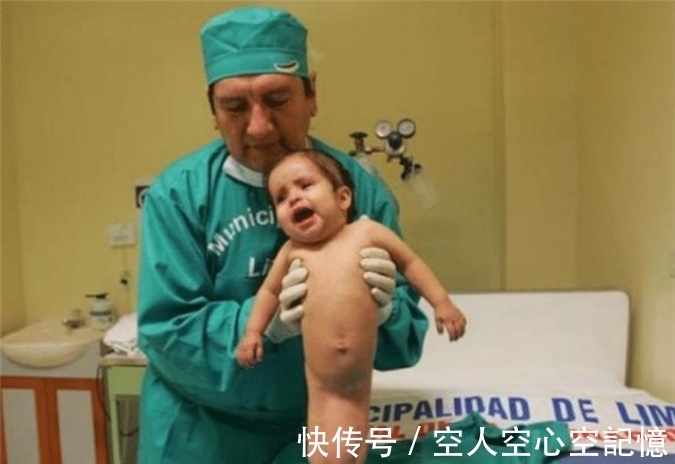 早夭|美国女孩出生患美人鱼症,喜欢在水里,生存十年创造医学奇迹