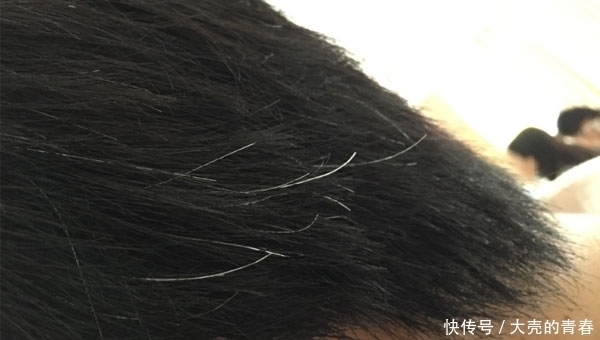 癌症|容易长白发的人,不会轻易得癌?有科学依据吗?医生告诉你答案