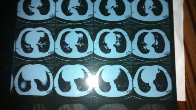 遗传史|长期吸烟身体却安然无恙的人,多半有4个共同点,你符合几点