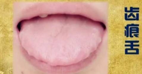 炙甘草|“齿痕舌”摊上大事了!是癌变征兆老中医支3招帮你健脾祛湿!