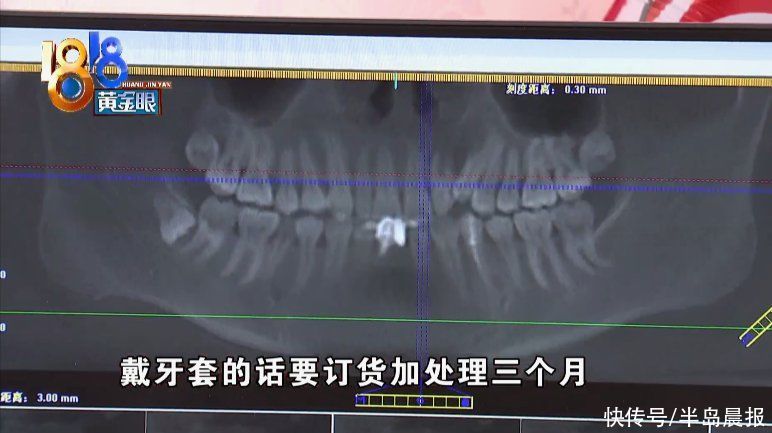  种植牙|牙都拔了才知道，植骨可能会失败？