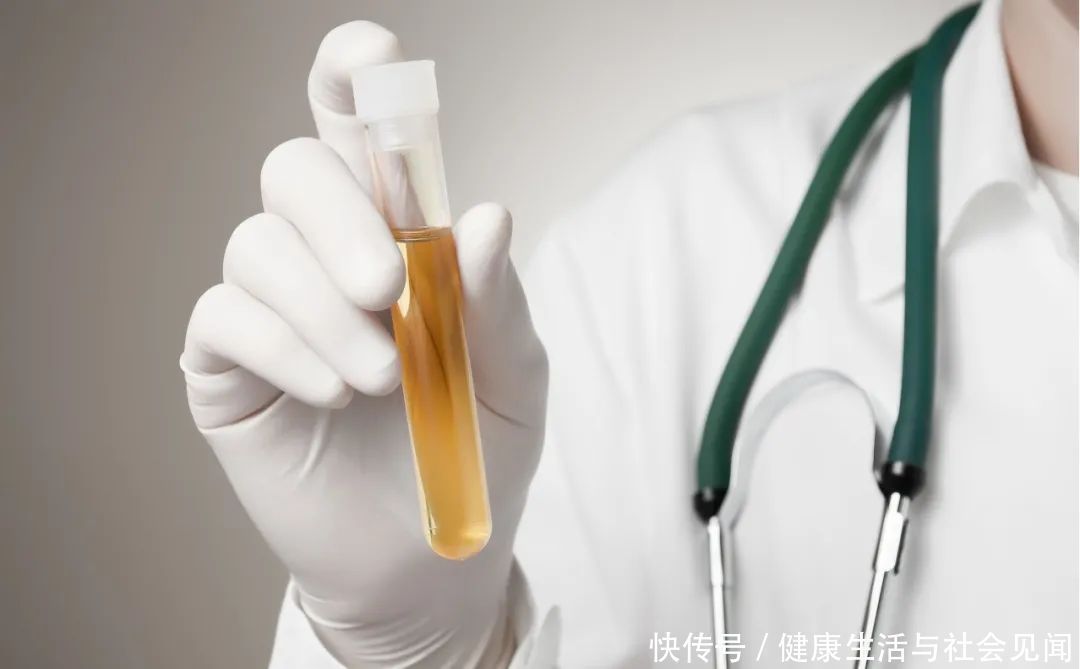 从尿液颜色看身体健康晴雨表