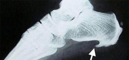 骨质增生|离癌还远的，身上有没有4个“小突起”，占一个也好，你了占几个