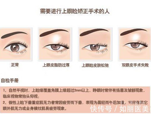 并发症 上睑下垂术后多久恢复自然?其实这1点才更该重视