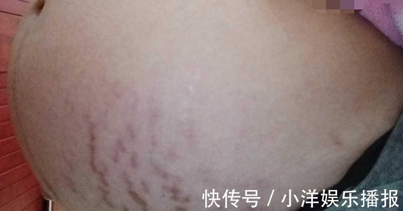 妊娠纹|怀孕7个月的孕妈每天抹油,但还是长了妊娠纹,医生的一句话扎心了