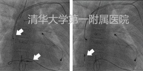 清华大学|11岁女孩心脏起搏器囊袋竟严重感染？看清华大学第一附属医院如何治疗！