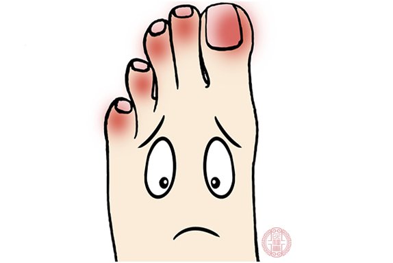 怎样治疗脚拇指外翻