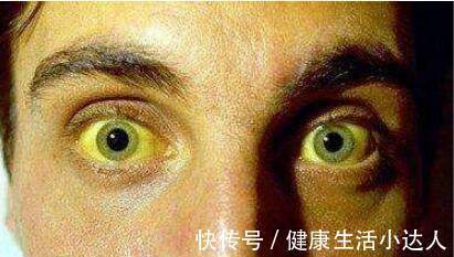 肝癌|肝癌的扩散速度有多快?出现5个表现,已进入晚期,时间不多了