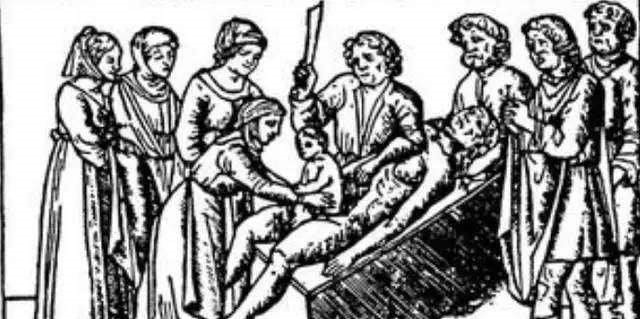 发明|西方发明的一种手术,早期死亡率高达85%,却给中国妇女带来福音