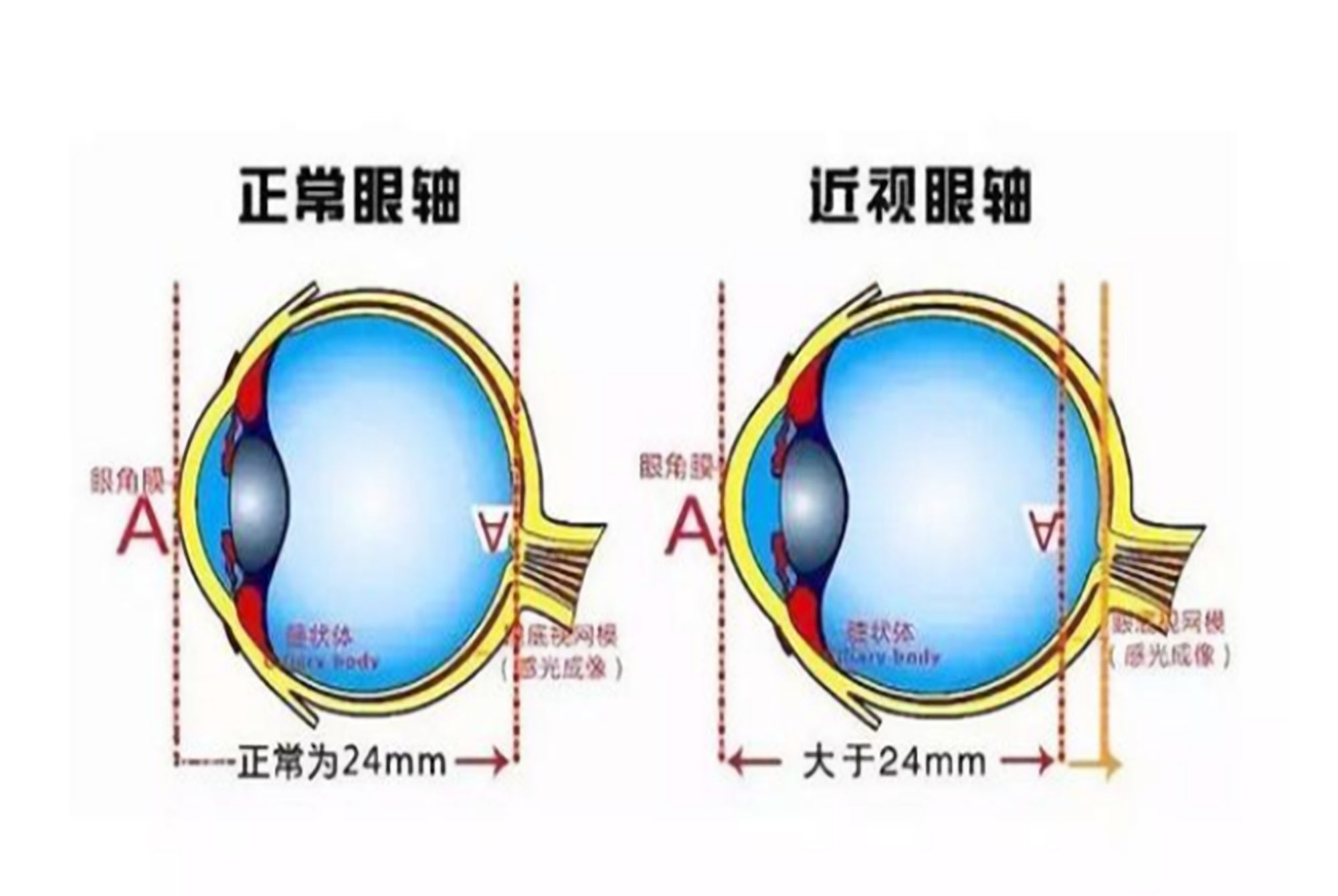 视力|为何儿童近视的人数在增加?医生说出“元凶”,但很多孩子喜欢玩