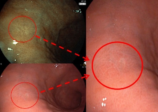 印戒细胞癌|女子在胃镜中查出小白点竟是癌!幸好发现的早