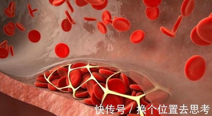 干细胞|中科西部干细胞研究院:干细胞治疗高血脂,有效改善血管硬化!