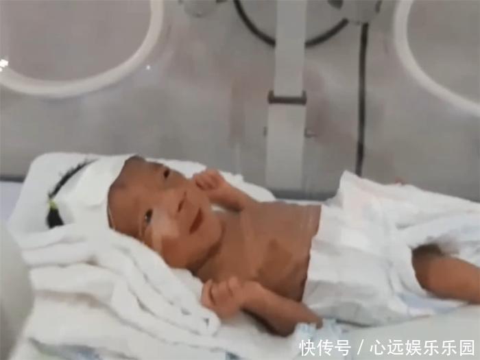 重900克的早产儿,第一次见妈妈就笑了,宝宝的腿却让妈妈泪崩