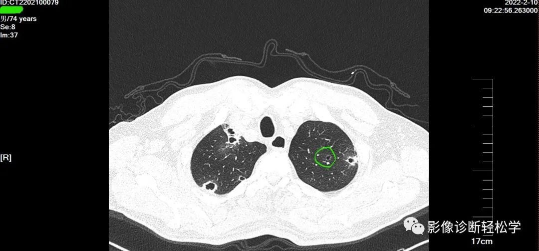 金葡菌|快快乐乐过大年，轻松学习肺部影像 实战篇 续