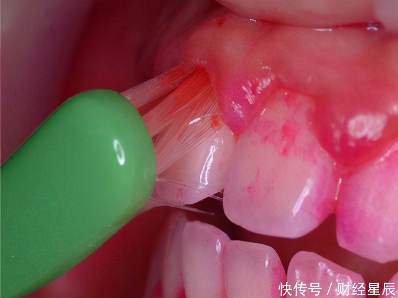 解答|肝病在诊断之前,会有哪些“先兆”出现?肝病医生为你解答