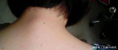 胸前背后总是长痘痘该怎么办?