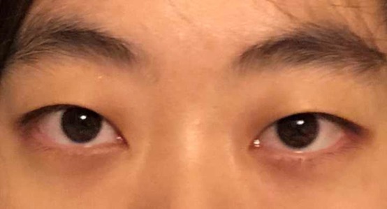 脂肪肝|拜拜了,肝炎,拜拜了,脂肪肝,拜拜了,肝硬化