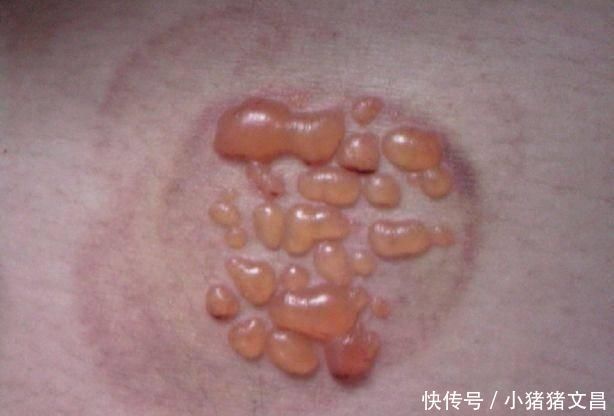 拔罐拔出的淤血和水泡,真的是体内的毒素吗