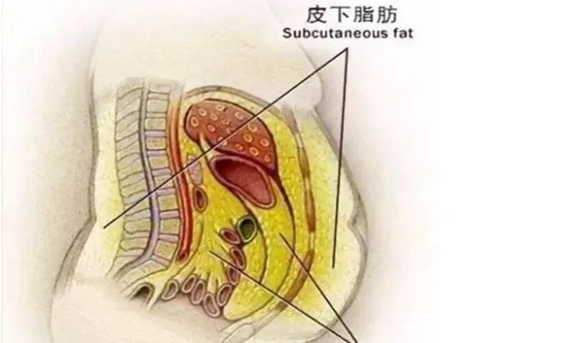 清除|剖腹产顺便清除脂肪，产妇一顿神操作，生娃还能减肥？