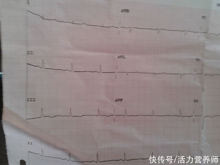 体检报告写“窦性心律不齐”,指的是什么?一次性给大家讲清楚