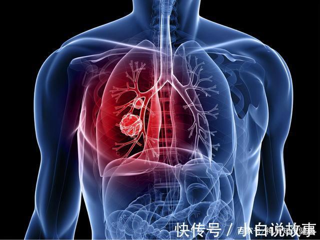 防护|医者不自医专家患癌三年没有复发,关于肺癌防护,他有话要说