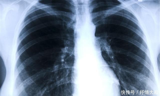  提醒|肺癌的症状有哪些？提醒：发烧若有这些特点，可能是肺在呼救