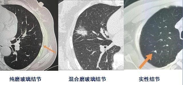 治疗|两个肺癌病人都拖了2年才治疗，一个治愈，一个扩散了