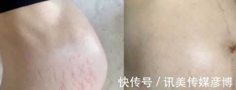 孕纹|长了妊娠纹就没救了？别交智商税，做好这些事，和妊娠纹说拜拜