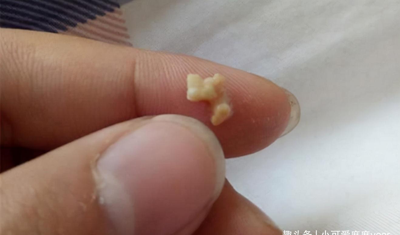 小明|同学嫌弃儿子“嘴太臭”,妈妈带孩子检查,医生取出的颗粒是真臭