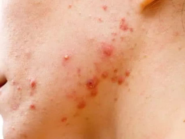 天天和螨虫睡长痘痘仅需要一片叶子,螨虫全部“一只不剩”