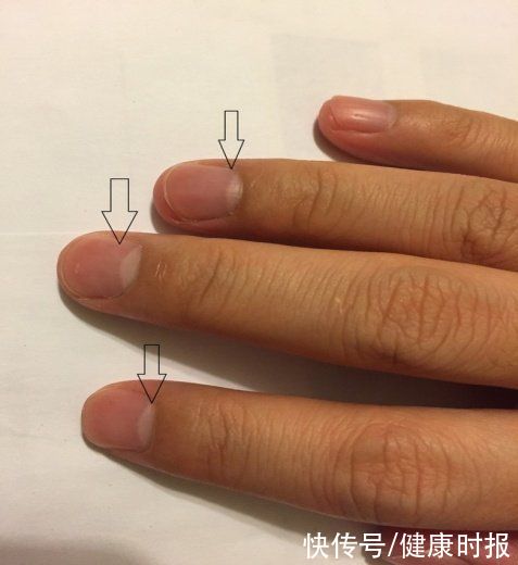 充血性|你的肾好不好,看指甲就知道!医生:指甲长成这样的要小心了