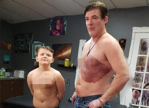 手术切除|小男孩因胎记感到自卑,爸爸一个做法获高赞,网友:最美“胎记”