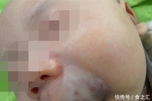 宝宝脸上是海绵状血管瘤吗?家长只要看是否出现这些症状